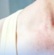 pessoa com a pele irritada, alergia, alergia e imunologia pediátrica