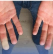 síndrome de raynaud, acompanhamento com reumatologista