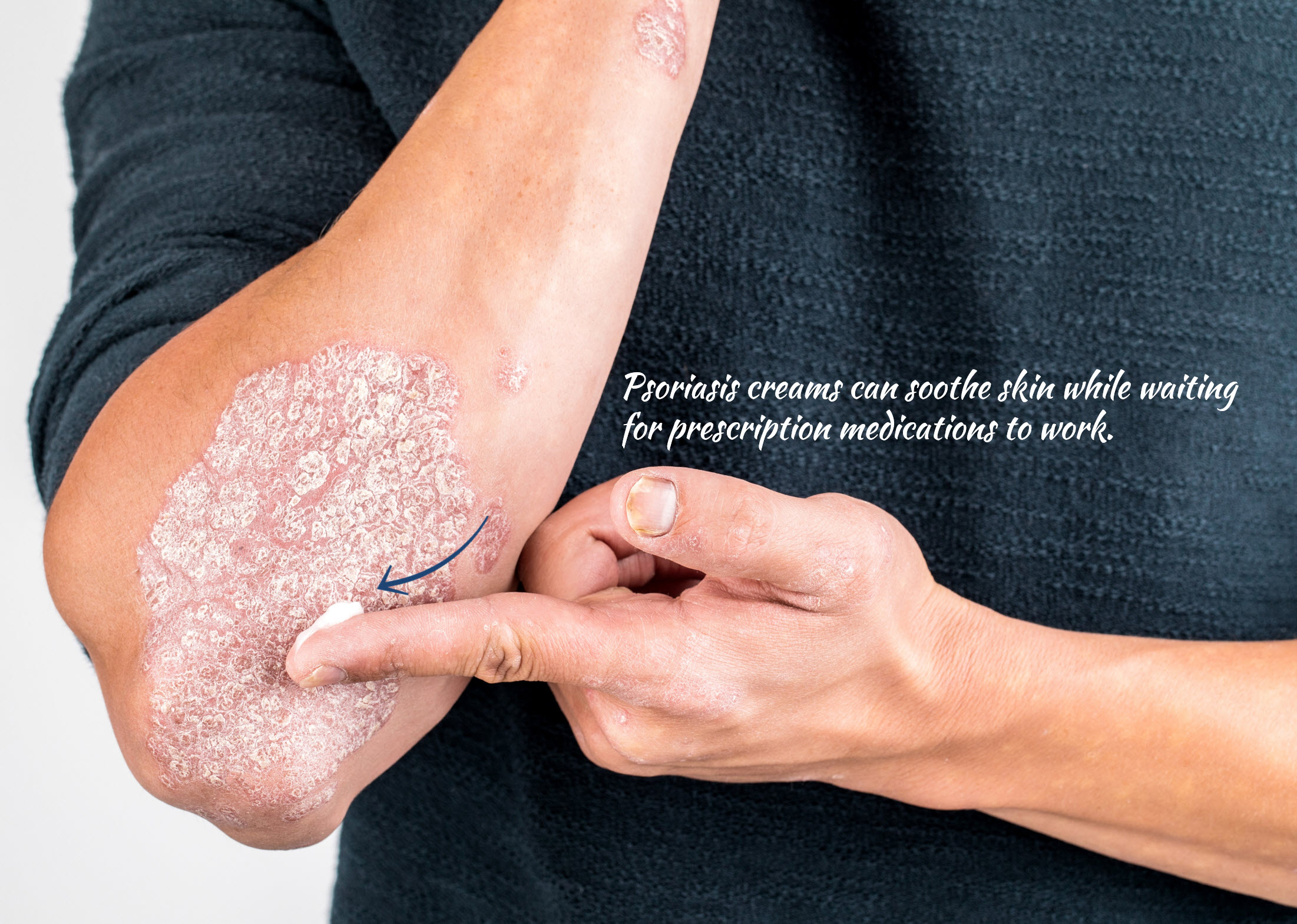 Psoriasis creams can soothe skin while waiting for prescription medications to work.