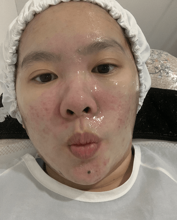 after facial selfie