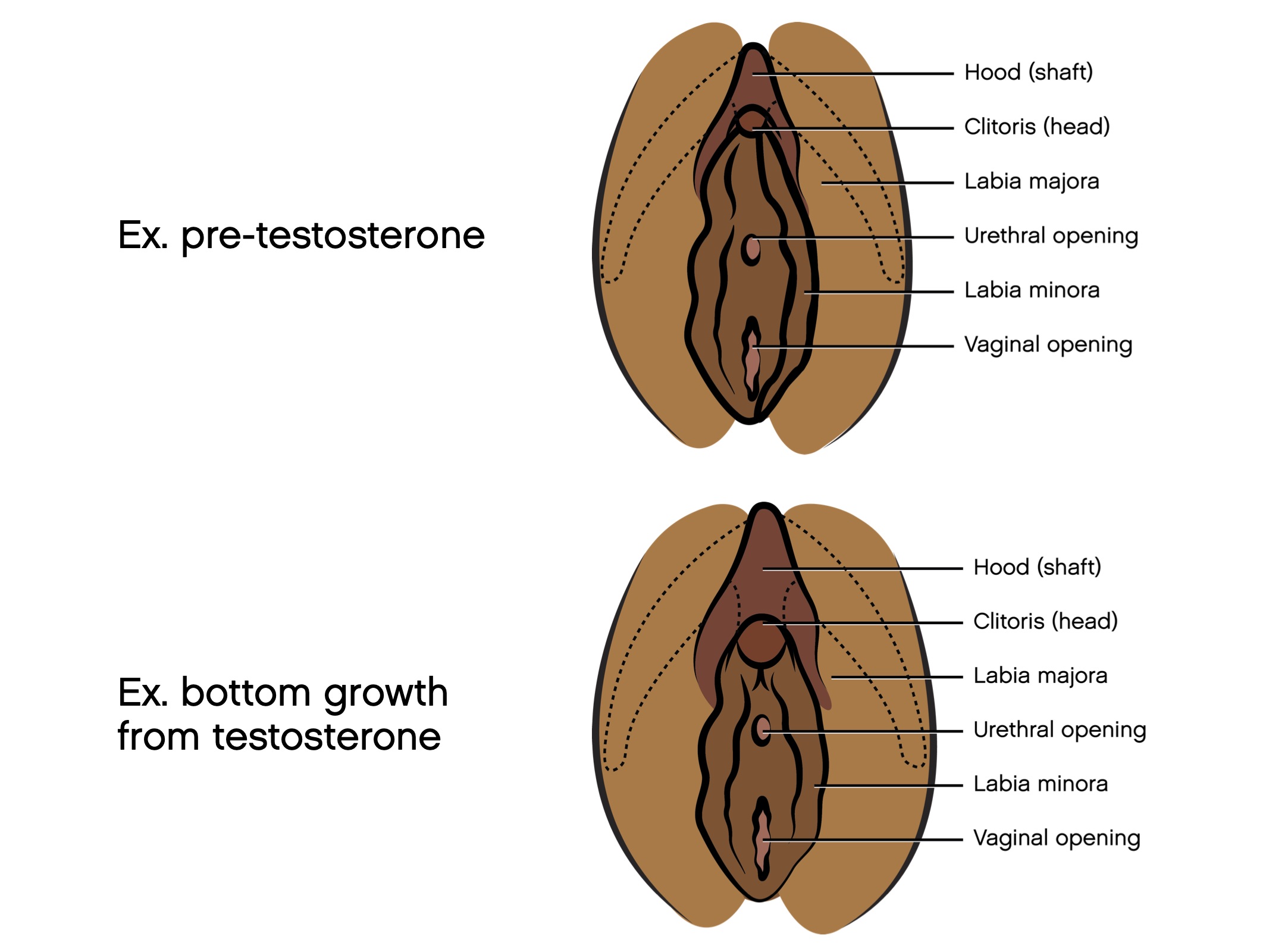 Bottom growth" typically means the clitoris and clitoral hood will get...