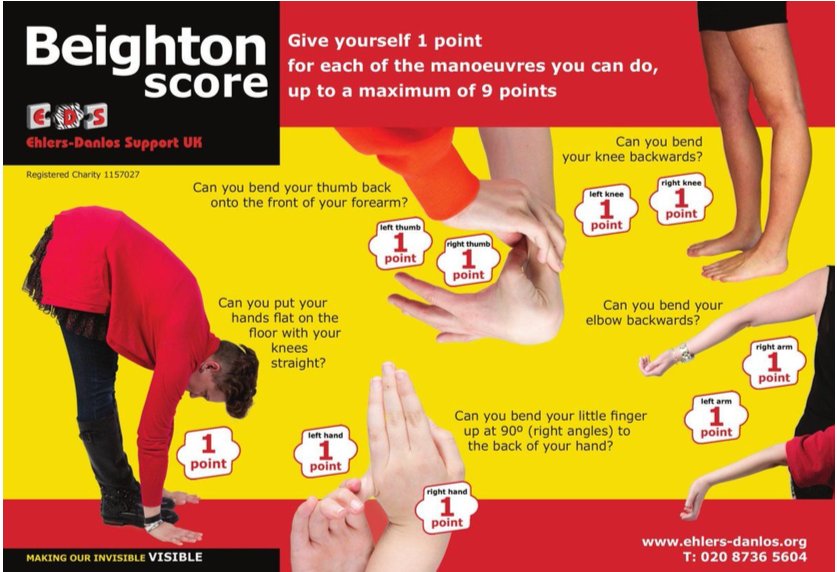 Beighton score