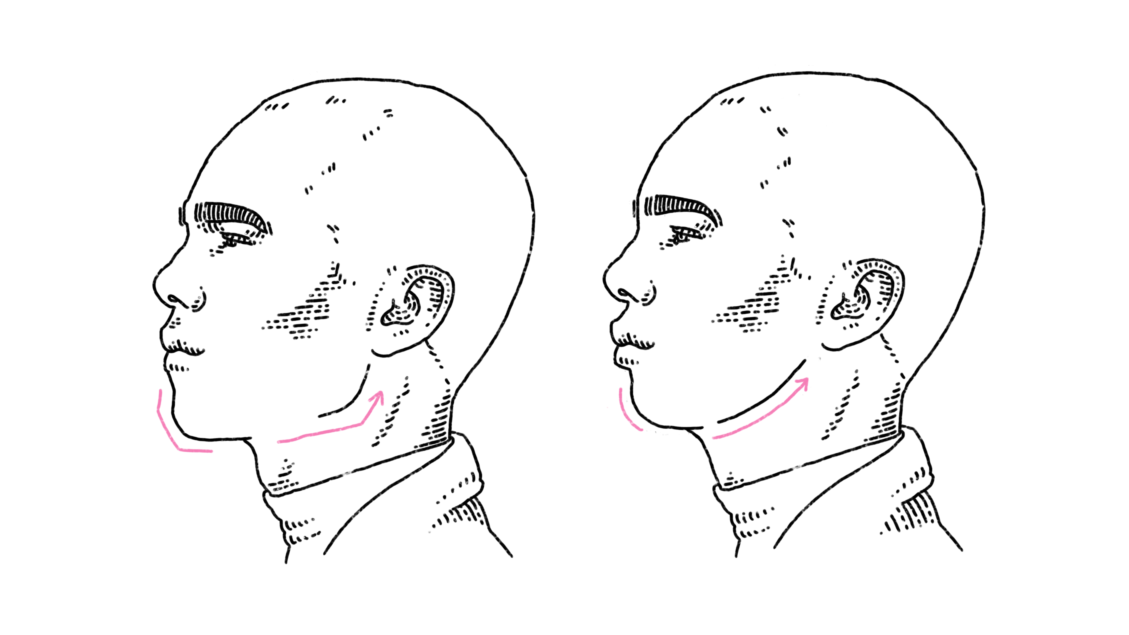 Facial Feminization illustration