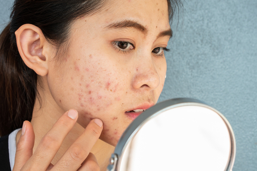 Young woman examining her acne