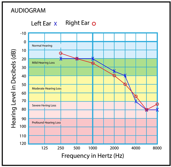 What Is An Audiogram And How Do You Read It