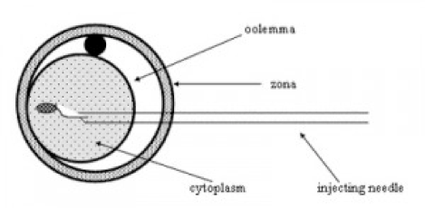 Diagram of ICSI-sperm injection