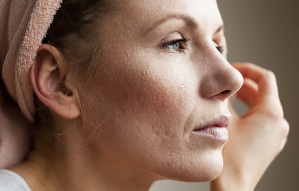 A woman with acne scars with her chin in hand