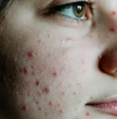 desequilíbrio hormonal, menina com espinha no rosto