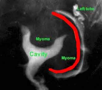 HSG image of uterus with fibroid complication