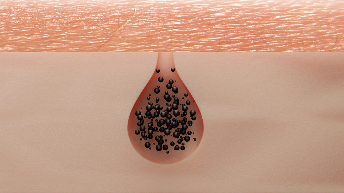 image of a clogged skin pore open comedone