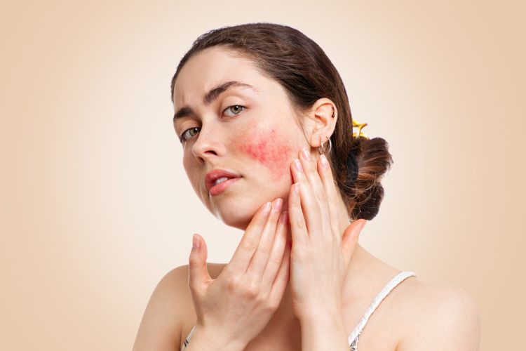 Woman with angry red cheek acne
