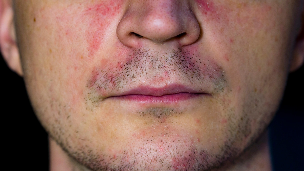 men with red pink rosacea patches on cheeks and face