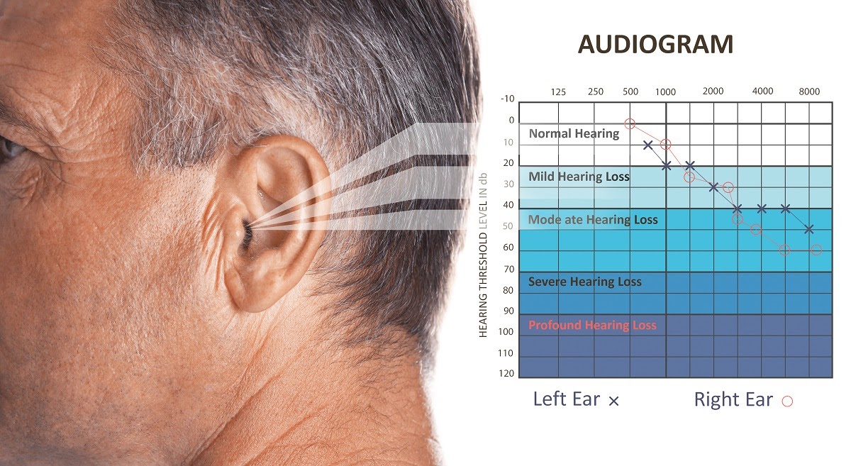 Hearing test results: A closeup of a man's ear with an audiogram to the right