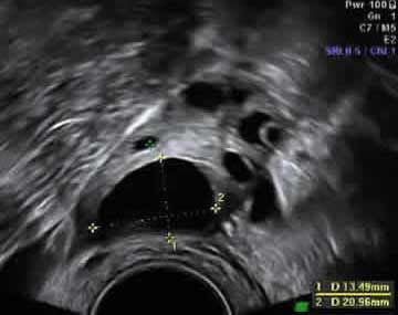 normal-ovary-mature-follicle (1).jpg