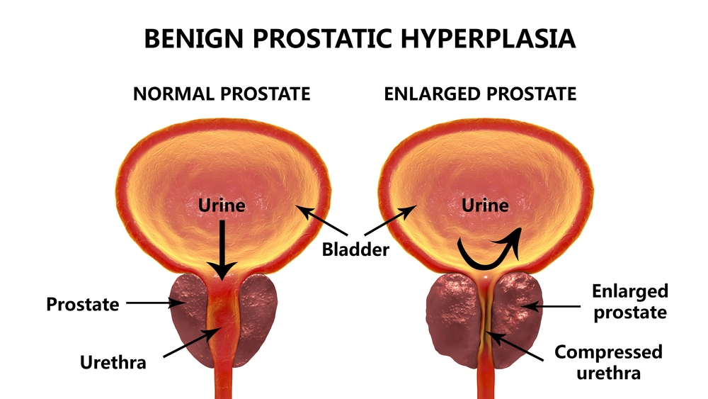 A diagram of a normal prostate vs enlarged
