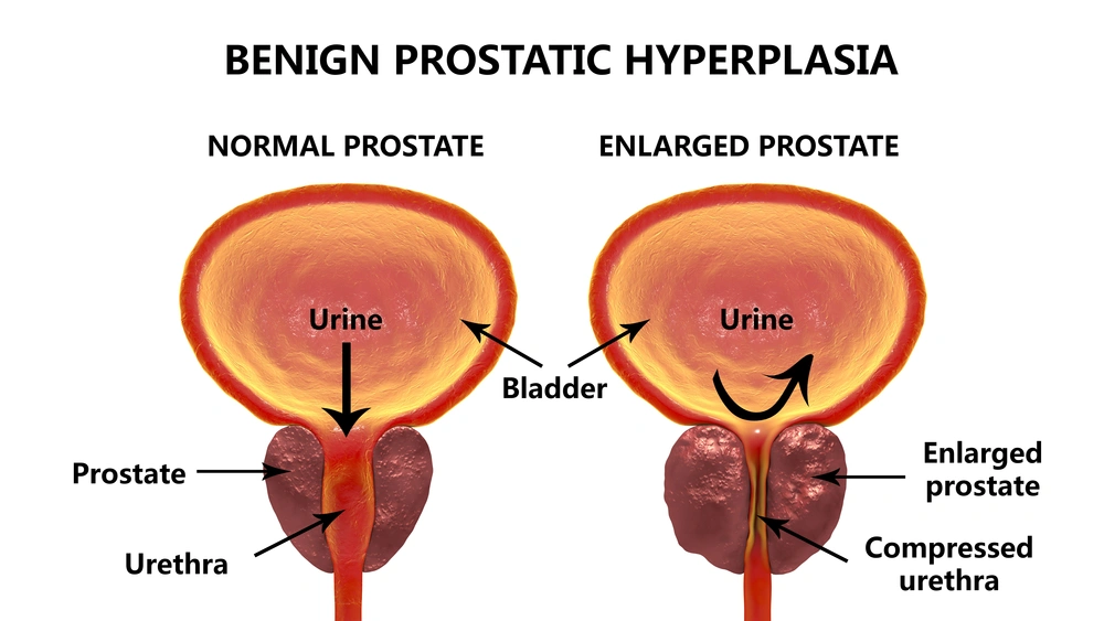 Prostate Massage Therapy Definition Types And Risks Kienitvc Ac Ke