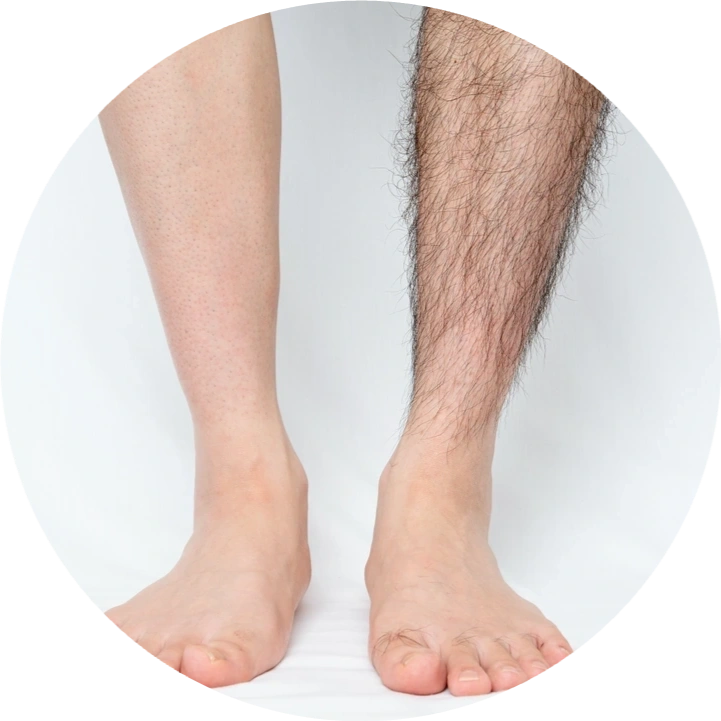 Loss of Leg Hair in Men