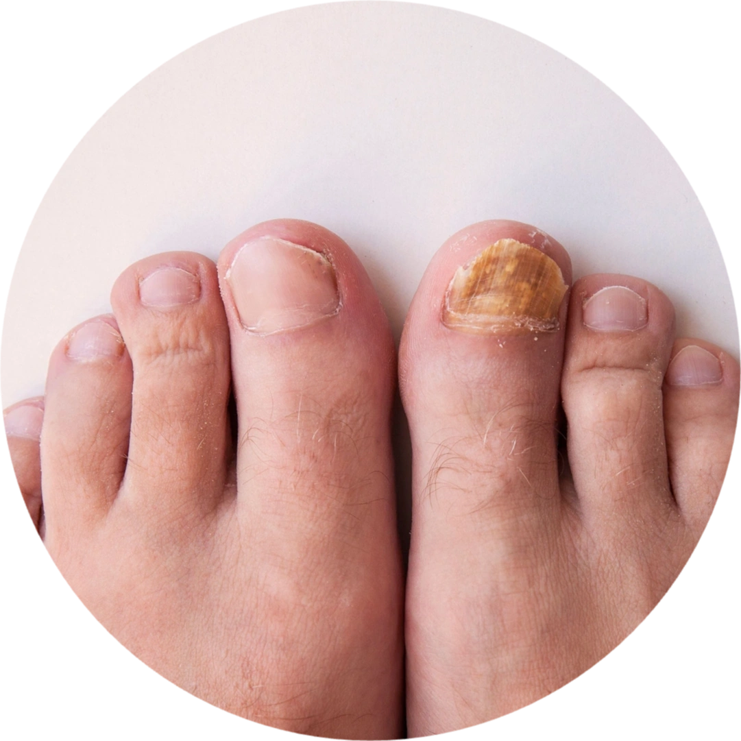 Toenail Fungus: How Does Fungus Get in There?!