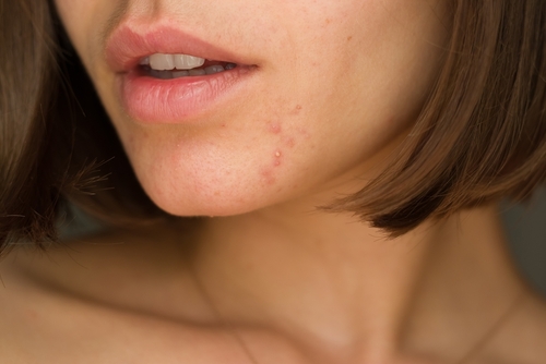 Mild acne on chin