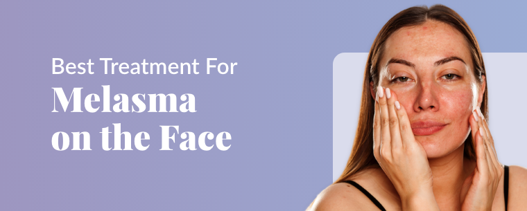 Best Treatment For Melasma On The Face 6761