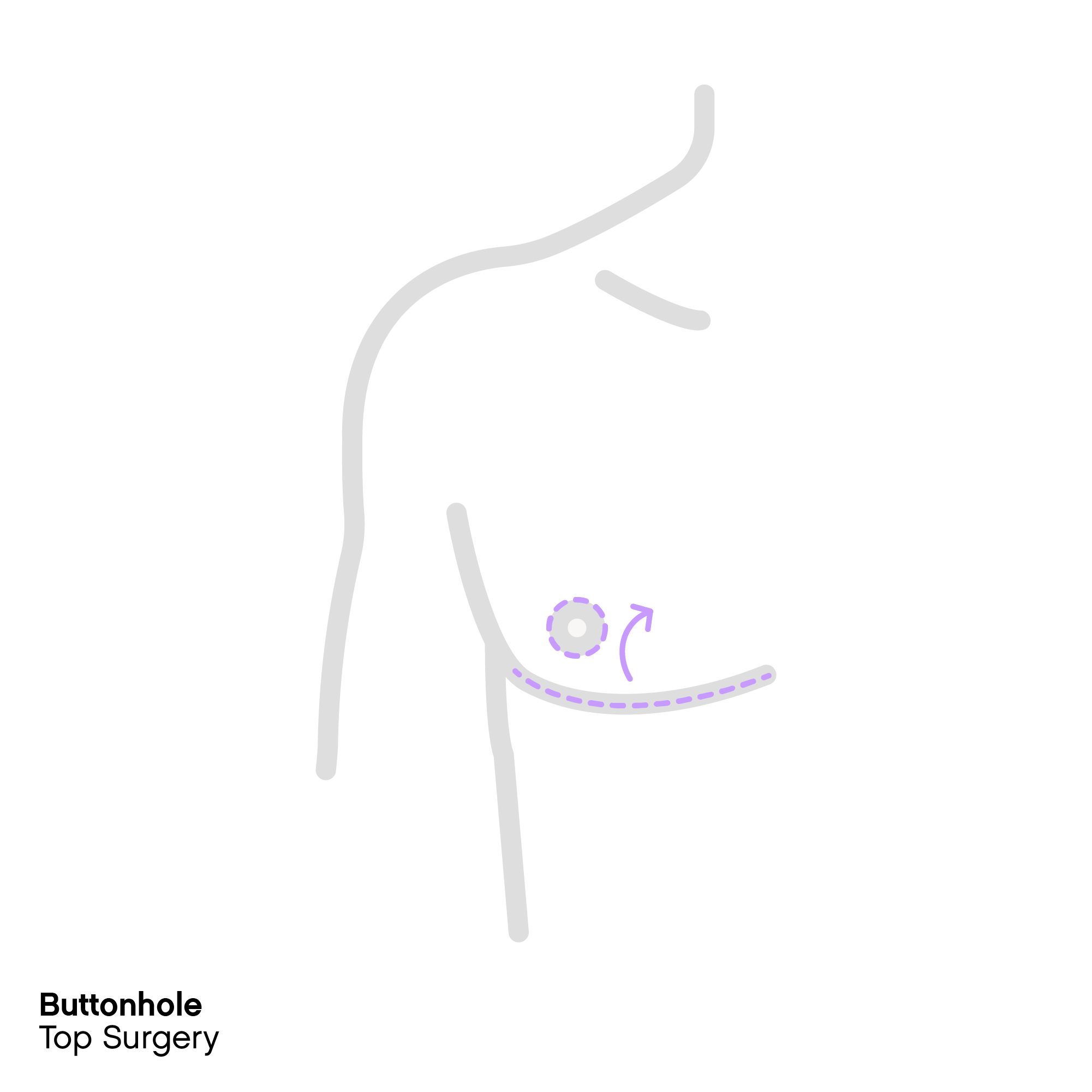 Buttonhole top surgery