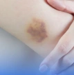 pessoa com mancha roxo no corpo, investigação em consulta com hematologista