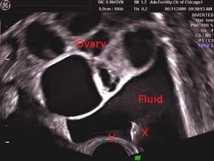 Paracentesis for OHSS