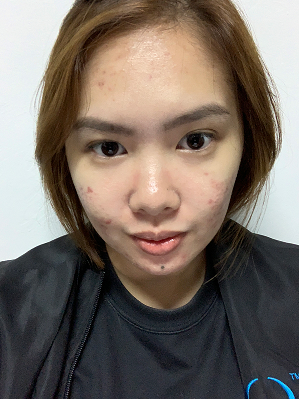 Skin currently healing as of March 2019
