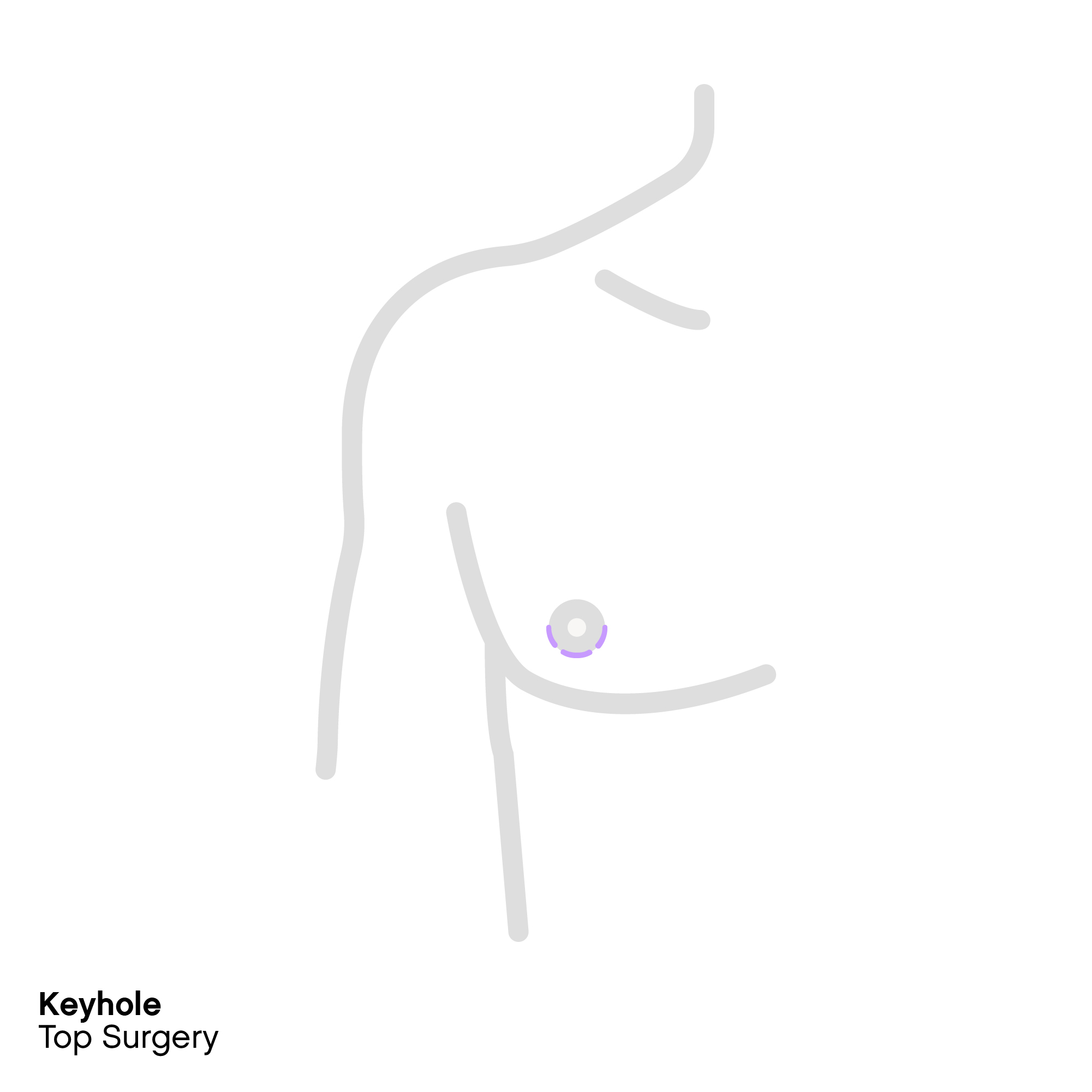 Keyhole top surgery
