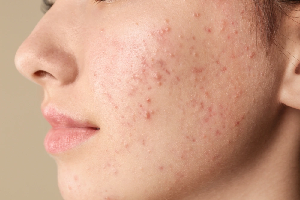 Woman with minor acne