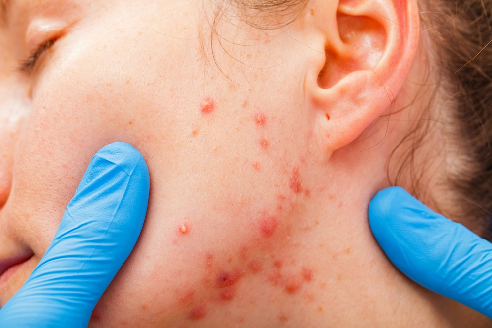 Doctor with gloves examining woman's acne