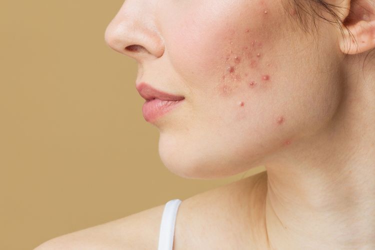 Woman with acne on her cheek