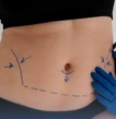 paciente que irá passar por lipoaspiração