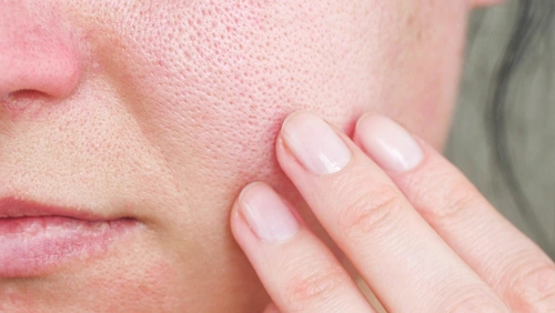 A closeup of a woman's pores on her face