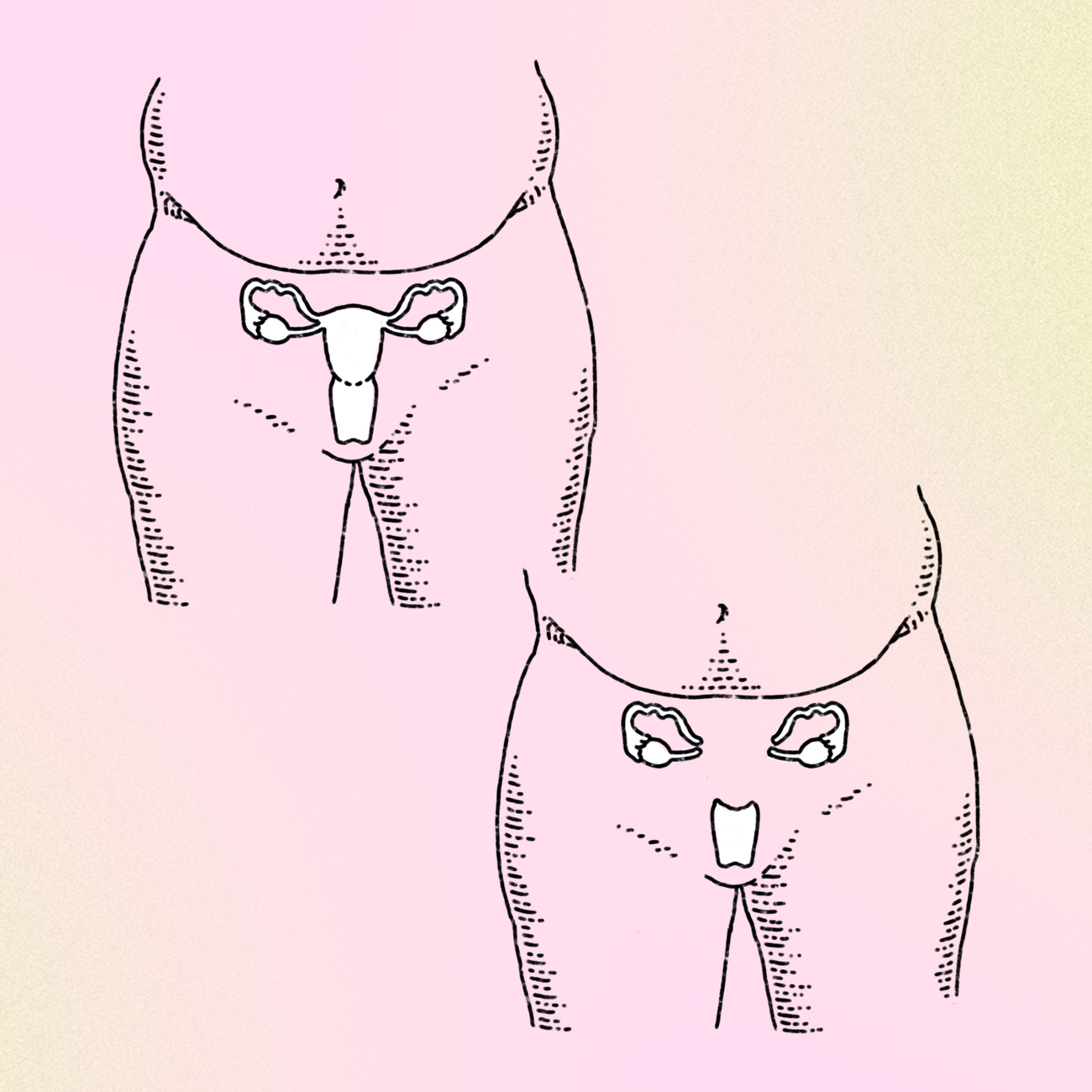 An example of a pelvis before and after a hysterectomy.