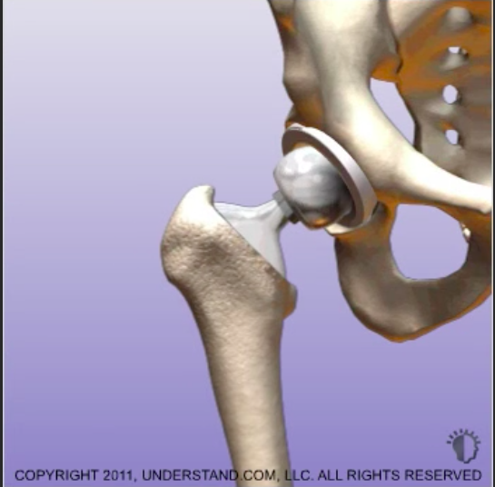 Как выглядит искусственный тазобедренный сустав фото