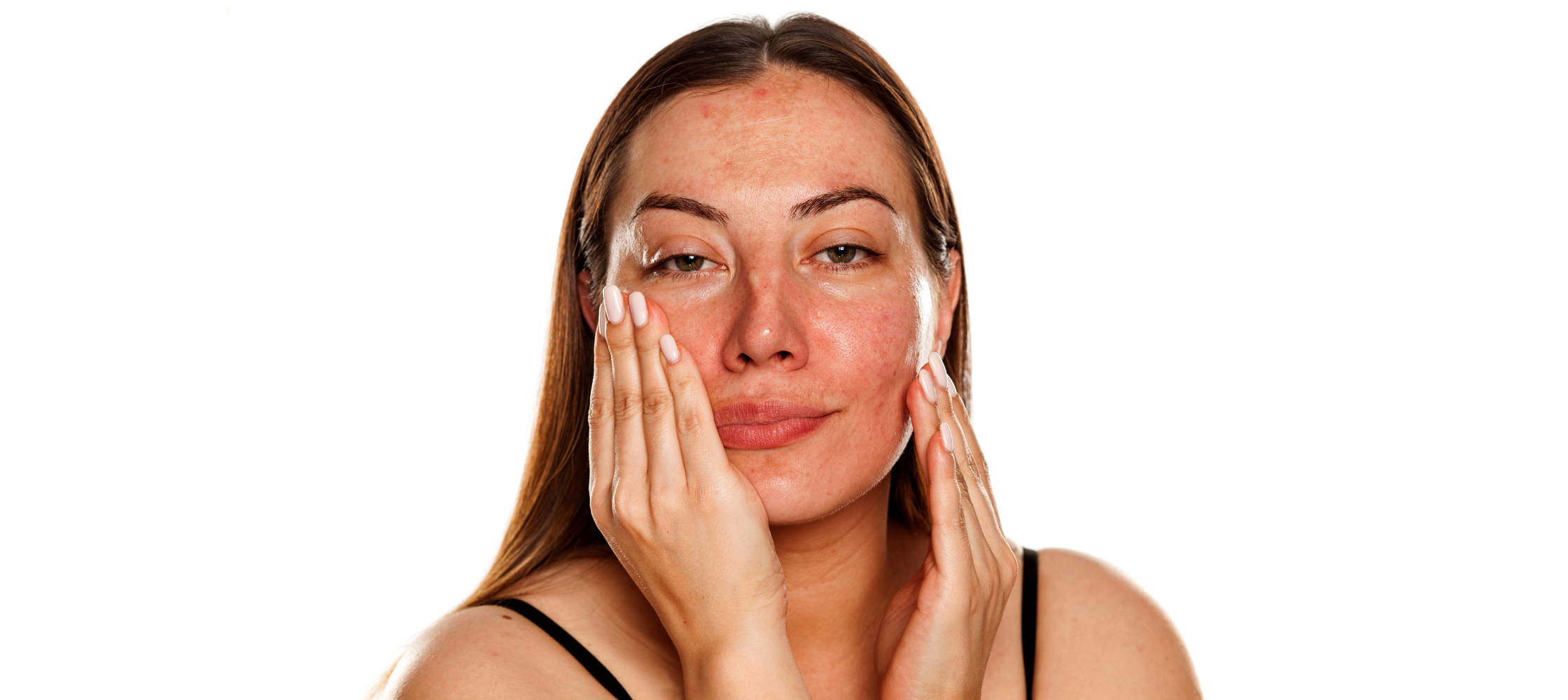Woman with dark spots on face discussing How To get Rid of Melasma