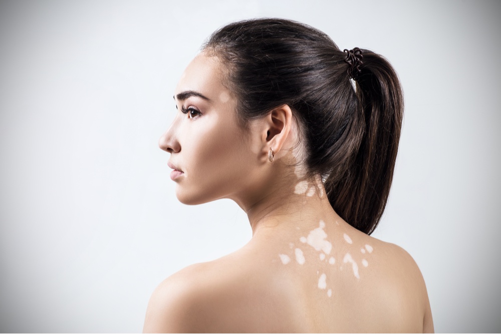 Woman with vitiligo