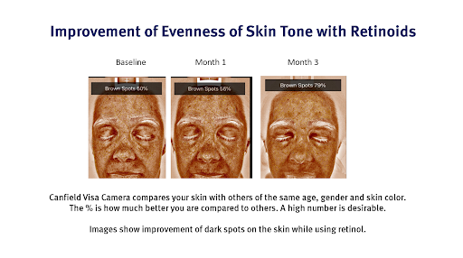 Improvement Of Uneven Skin Tone With Retinol
