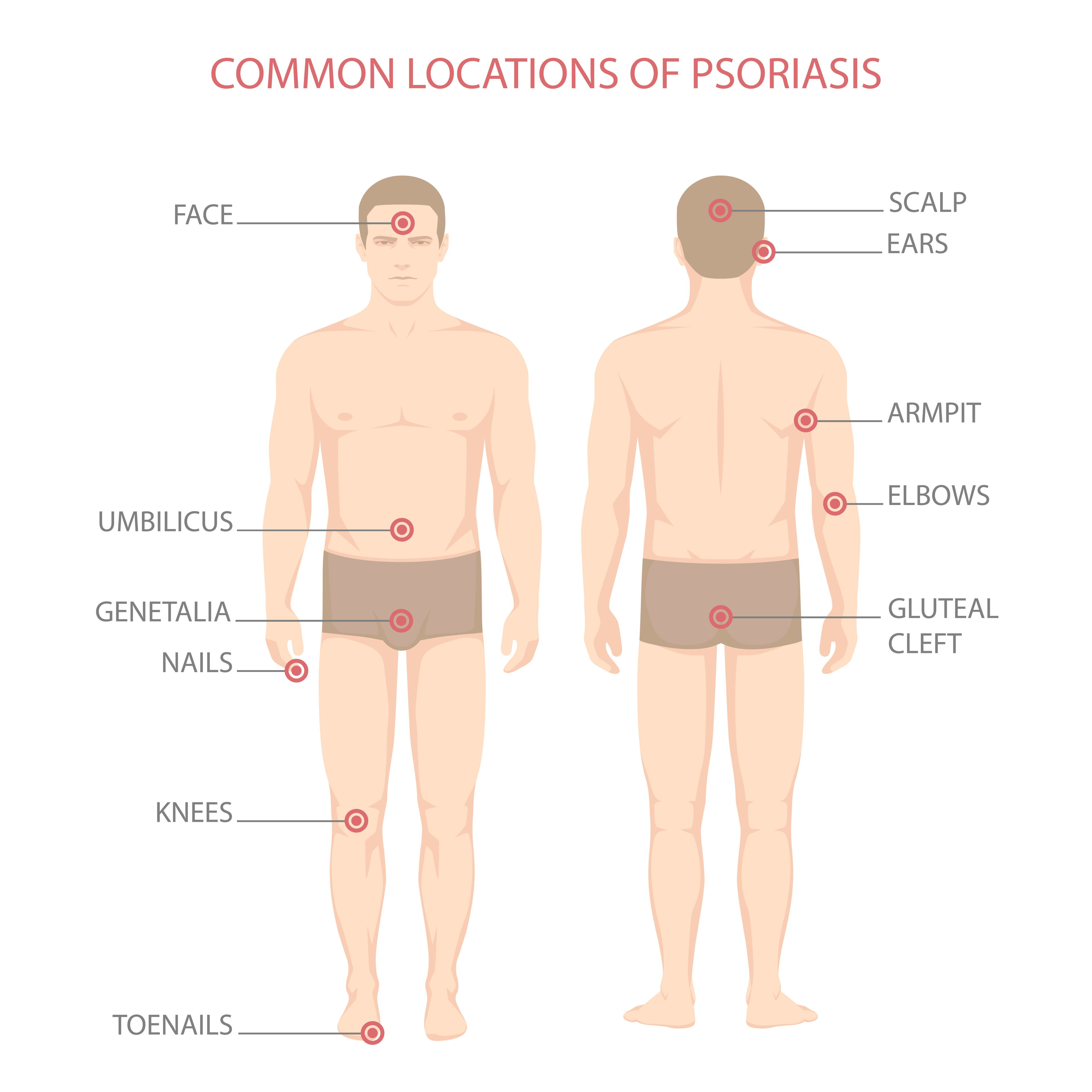 Common locations of psoriasis