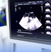ecocardiograma, exame cardíaco