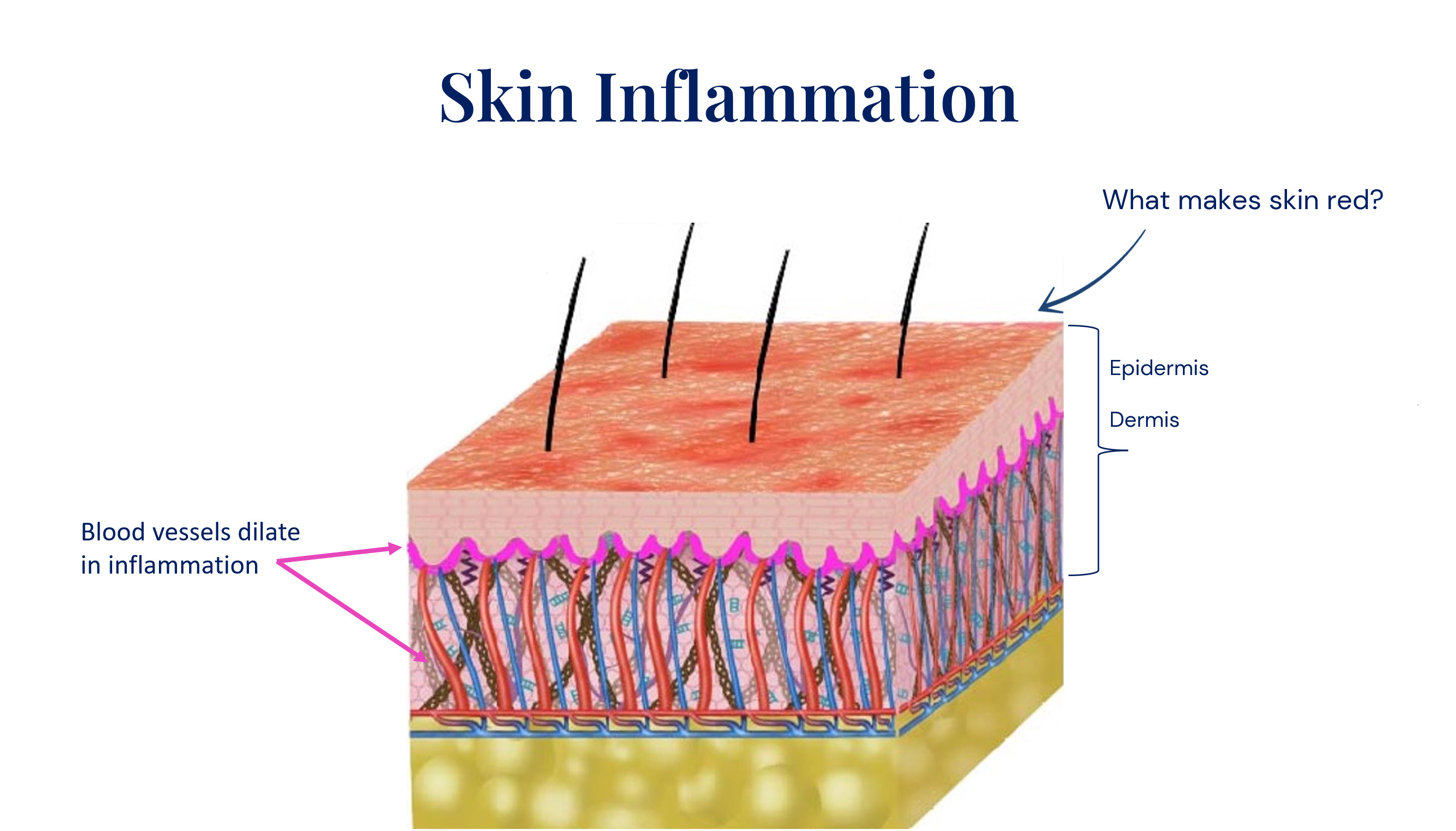 Cross section of skin with redness on skin surface showing inflammation of skin