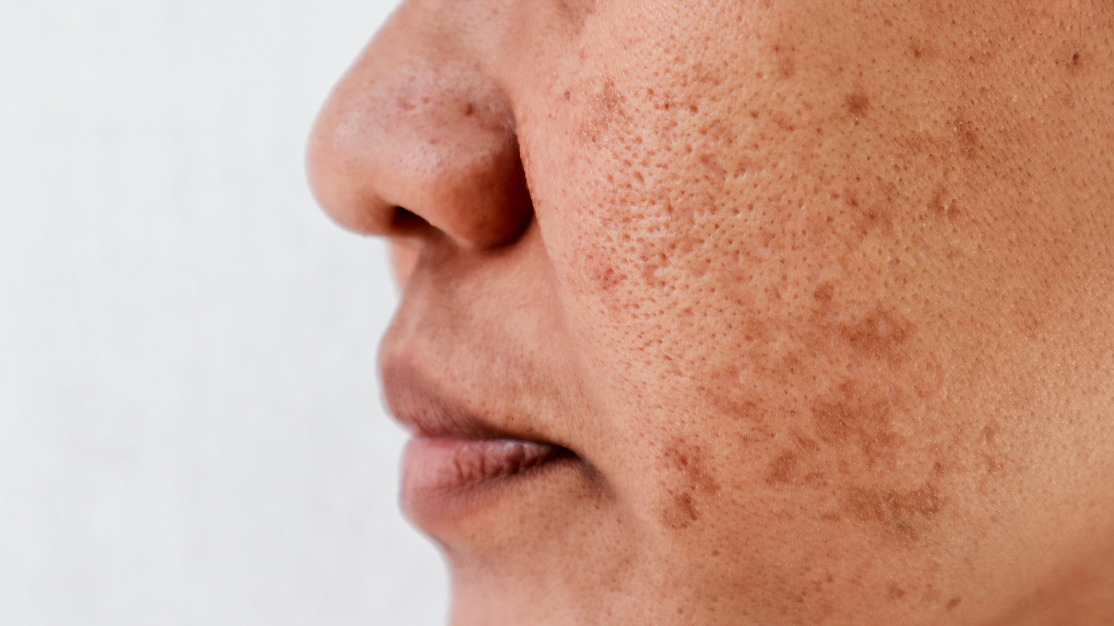 how to treat inflammation and hyperpigmentation