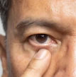 Homem indicando doença nos olhos