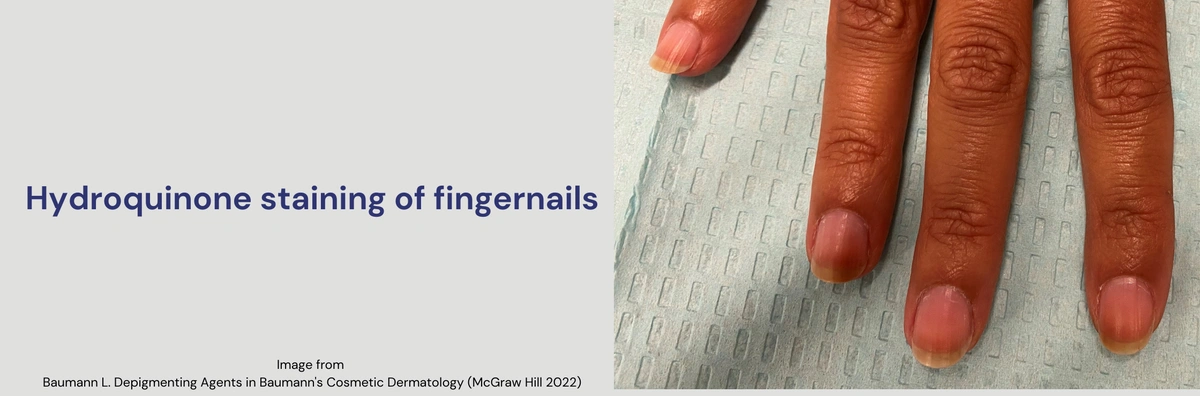 Hydroquinone staining fingernails.jpg