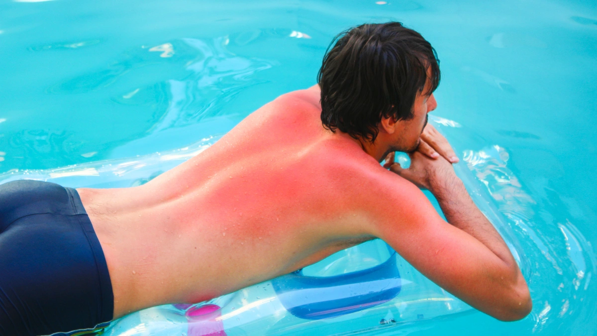 man on a raft with a sunburn due to a drug that made him have a sun allergy