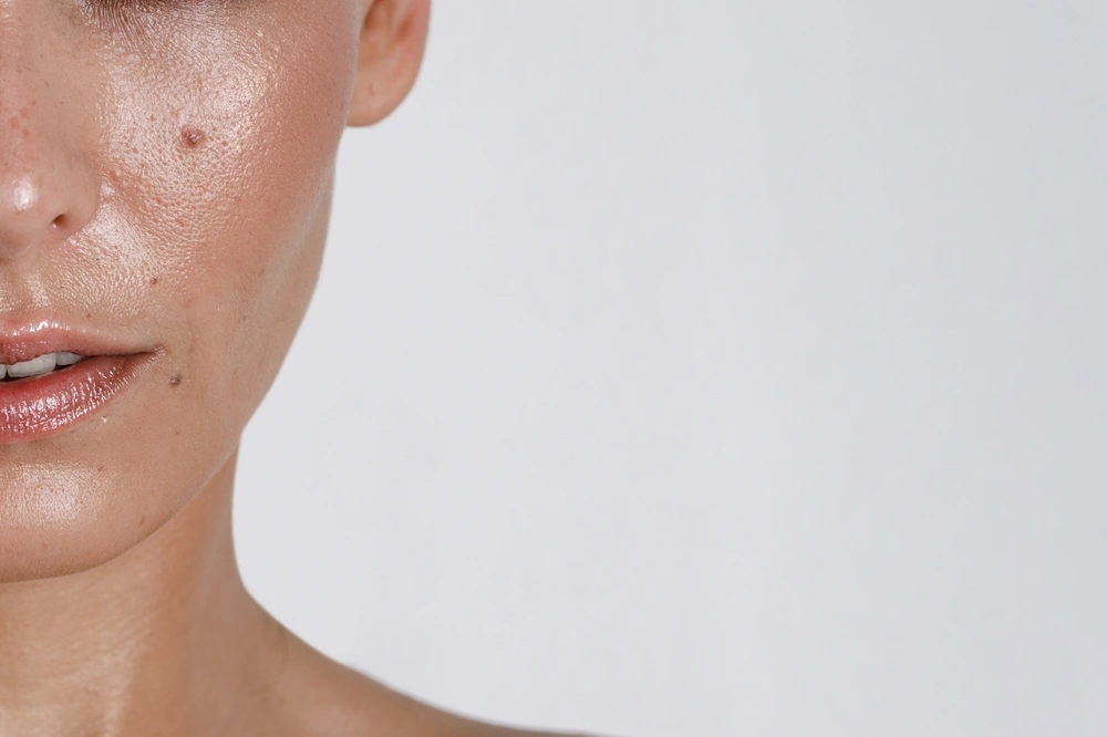 Everything To Know About Oily Skin And T-Zone Acne