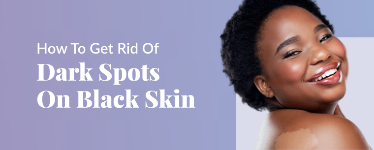 dark spots on black skin