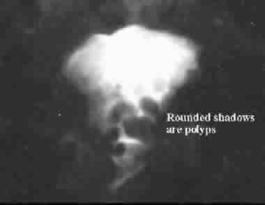 HSG image of polyps