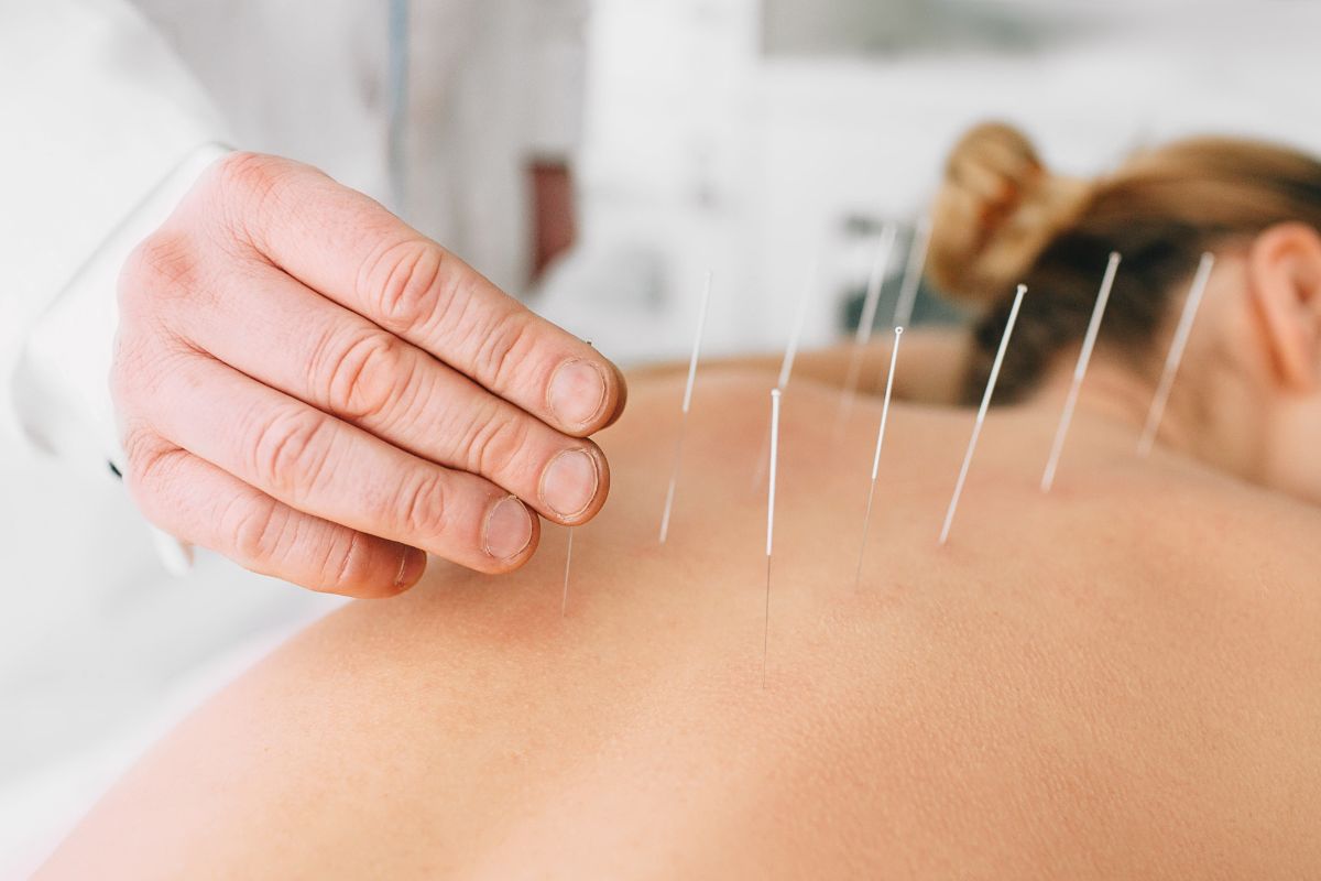 woman getting acupuncture therapy